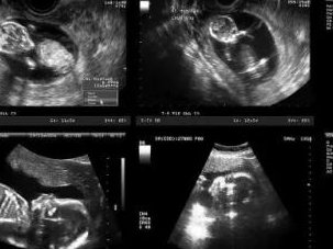 2026年济南试管婴儿费用大约多少